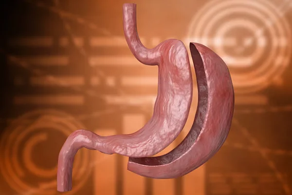 One Anastomosis Gastric Bypass