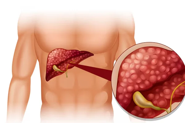 Laparoscopy in Various Liver Cysts