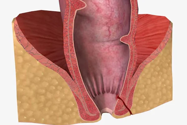 Video Assisted Anal Fistula Treatment