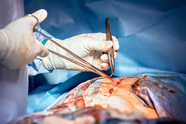 Laparoscopic Stomach Cancer Surgery