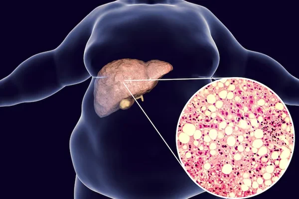 Laparoscopy In Various Liver Cysts