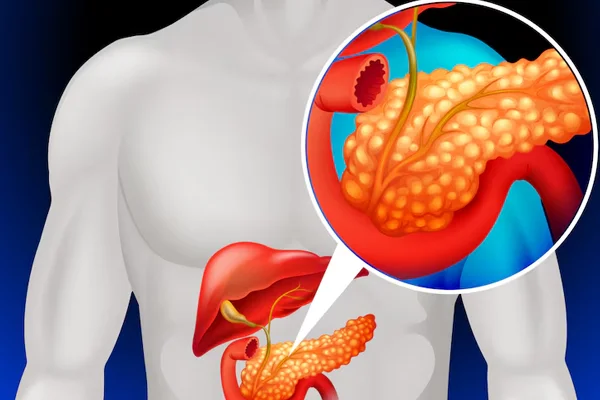 Common Bile Duct Stones